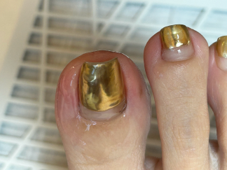 ingrown_nails1