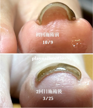 巻き爪施術例